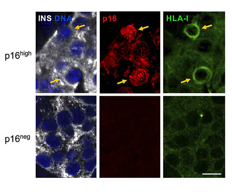 Senescent beta cells show high levels of proteins that display antigens to the immune system: Pancreatic islets from adult human subject stained for Insulin (INS) marking beta cells, for p16, and for HLA-I – the system by which cells display antigens to attract immune attack. Blue (DAPI) marks DNA. Arrows indicate p16high cells. Scale bar = 10 μm.